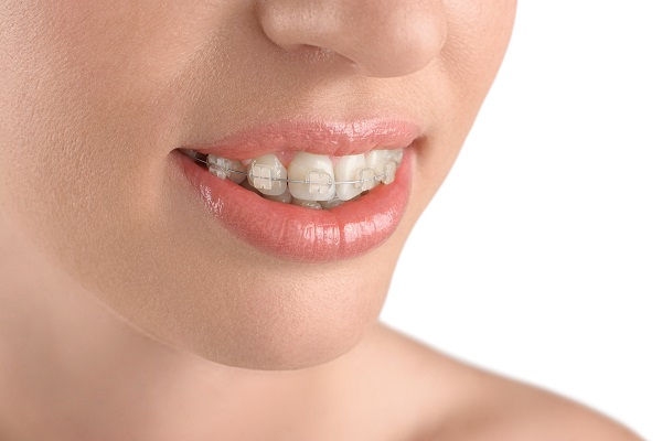 Consider Clear Braces For Straighter Teeth