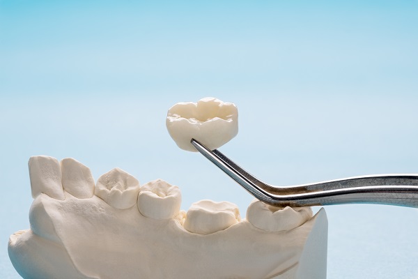 How Long Will A Dental Crown Last?