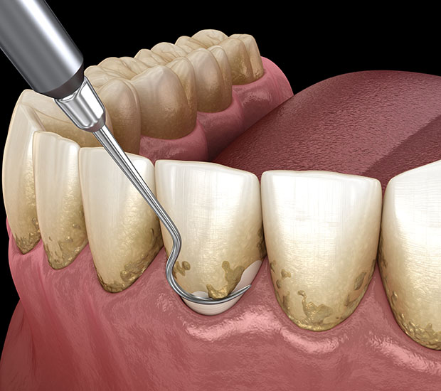 Orange Root Scaling and Planing